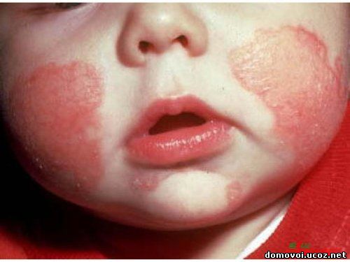 Пищевая аллергия у детей, фото